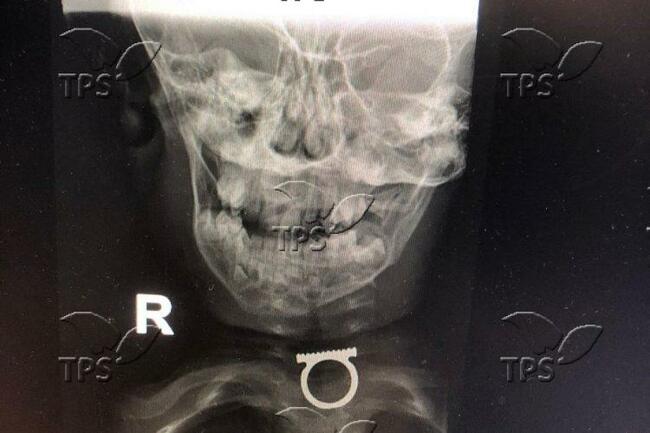 На рентгеновата снимка се вижда пръстенът